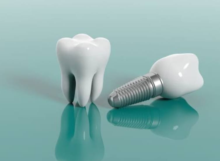 WHAT IS Dental Implant? /ડેન્ટલ ઇમ્પ્લાન્ટ શું છે?