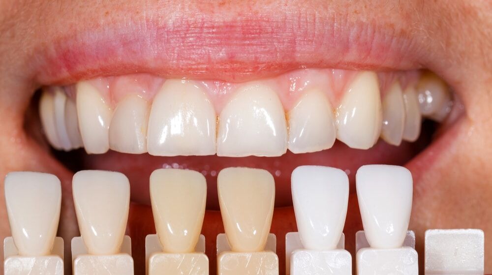 WHAT IS TEETH BLEECHING /TEETH WHITENING ? દાંત સફેદ કરવાની પ્રક્રિયા શું છે?