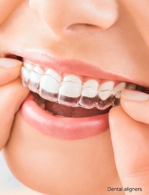 Invisible Aligners